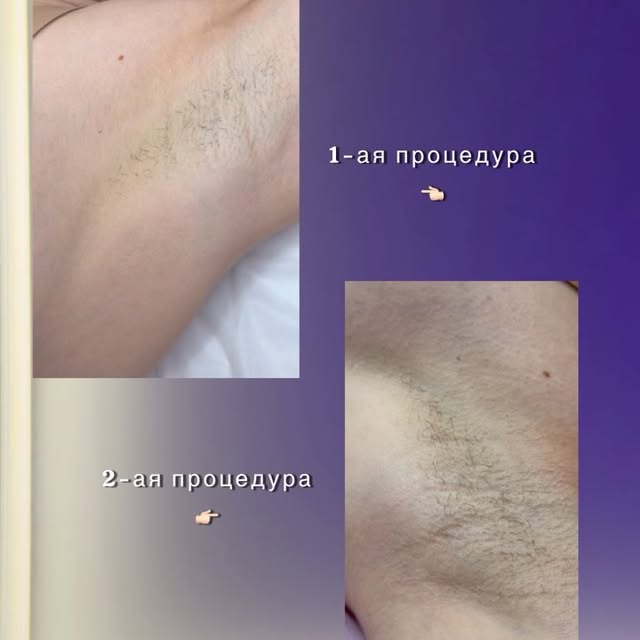 Электроэпиляция - Розовый рай